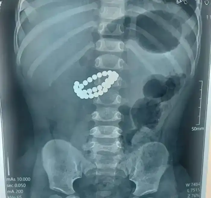 Хирурги в Алматы спасли ребенка после проглатывания 31 магнита