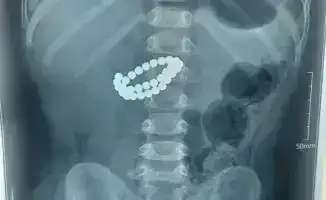 Хирурги в Алматы спасли ребенка после проглатывания 31 магнита