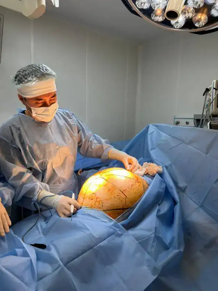 Успешное удаление 25-килограммовой опухоли в Алматы: влияние на здоровье пациентки и её дальнейшую реабилитацию