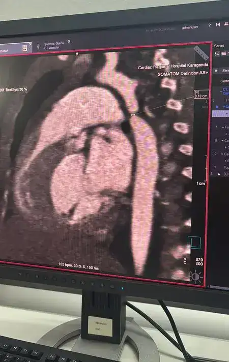 Шанс на жизнь: в Караганде впервые прооперировали младенца с коарктацией аорты (2)